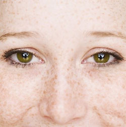 Солнечные брызги. Что делать с веснушками и пигментными пятнами весной?